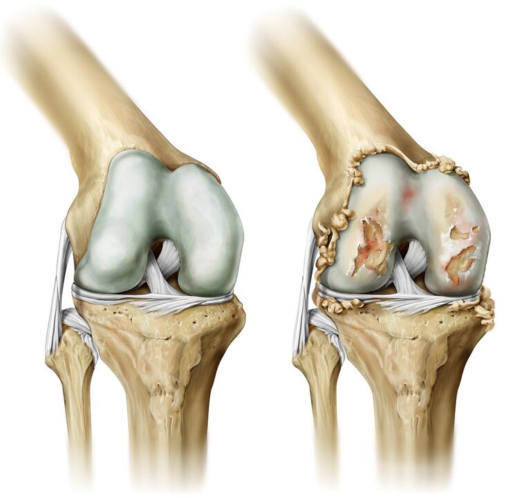 articulaciones destruidas por la artritis