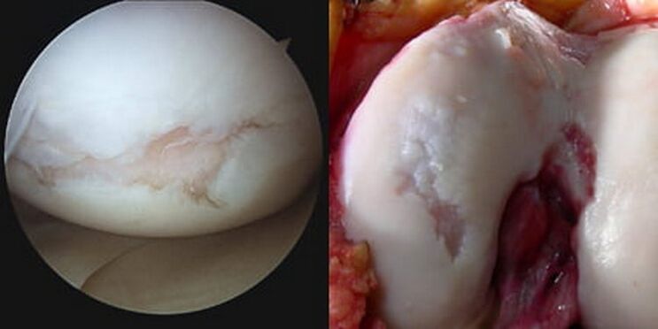 El daño a la articulación de la rodilla es visible durante la operación. 