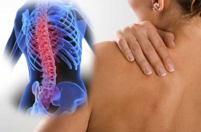 Con la osteocondrosis, el dolor puede irradiarse a áreas distantes del cuerpo. 