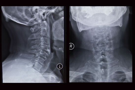 Radiografía de la columna cervical (el paciente tiene osteocondrosis)