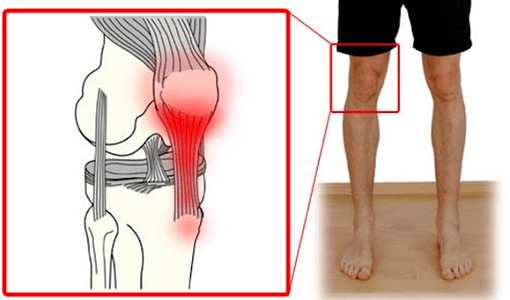 La tendinitis es la inflamación del tejido del tendón que causa dolor en la articulación de la rodilla. 