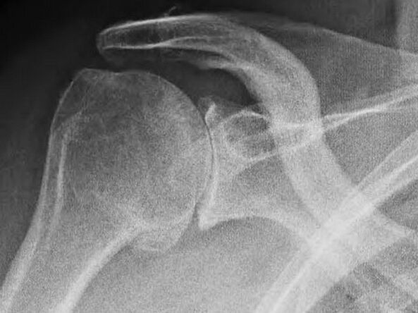 Radiografía de una articulación del hombro afectada por osteoartritis