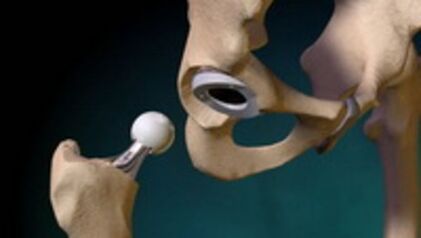 Problema para la articulación de la cadera