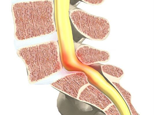 Segmento de motor de sangre para la osteocondrosis