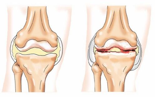 Articulaciones sanas y osteoartritis