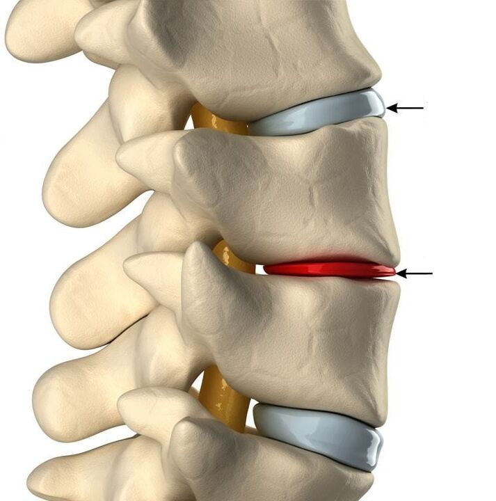 Diferencia entre un disco sano y un disco con osteocondrosis
