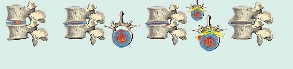 diferentes etapas de la osteocondrosis torácica