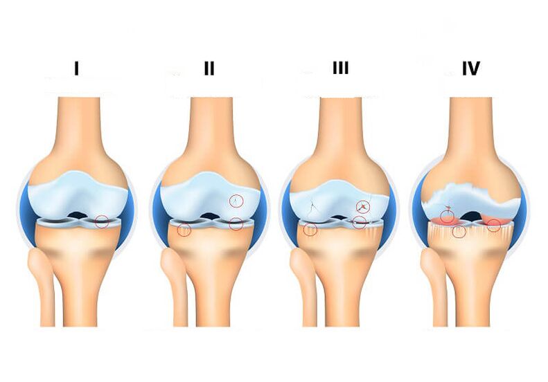 Etapas de la artrosis articular