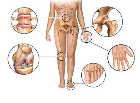 La osteoartritis afecta a varias articulaciones.