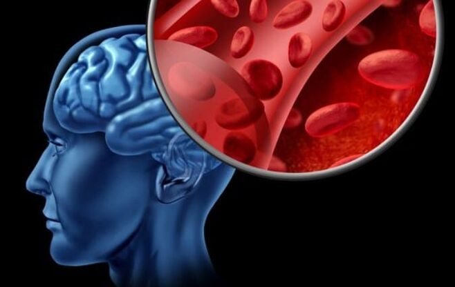 La osteocondrosis cervical puede provocar falta de oxígeno en el cerebro