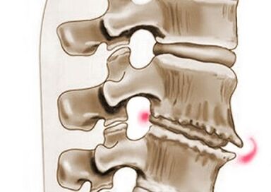 Daño a las vértebras en la osteocondrosis torácica.