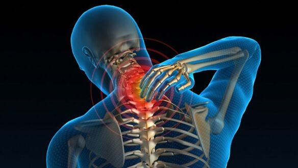 El dolor al girar el cuello puede indicar síndrome de osteocondrosis cervical vertebral.