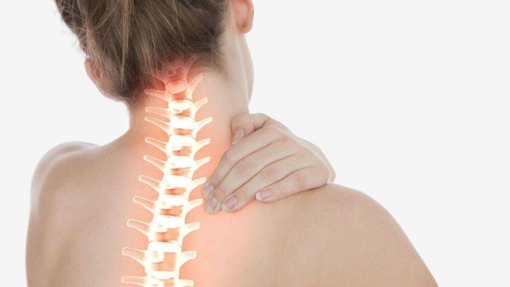 El síndrome radicular puede desarrollarse con osteocondrosis de la columna cervical.