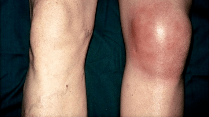 Osteoartritis y artritis