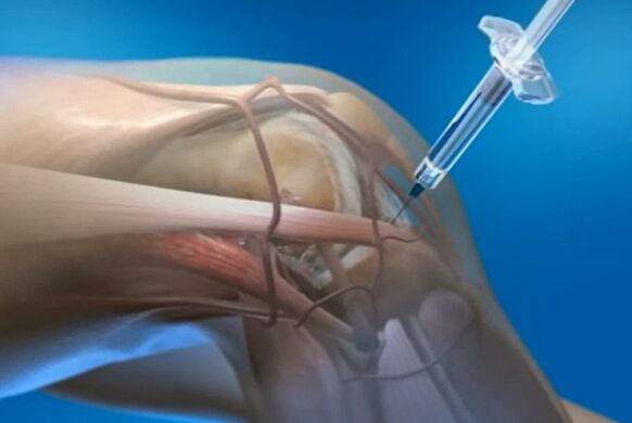 inyecciones intraarticulares para la osteoartritis de la articulación de la rodilla