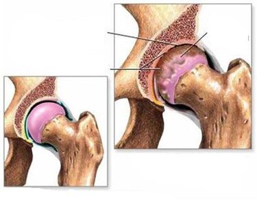 Artrosis de la articulación de la cadera
